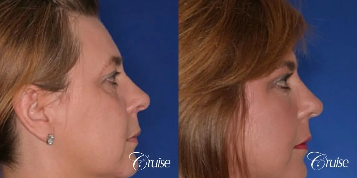 fat transfer with temple and lateral brow lift - Before and After 2