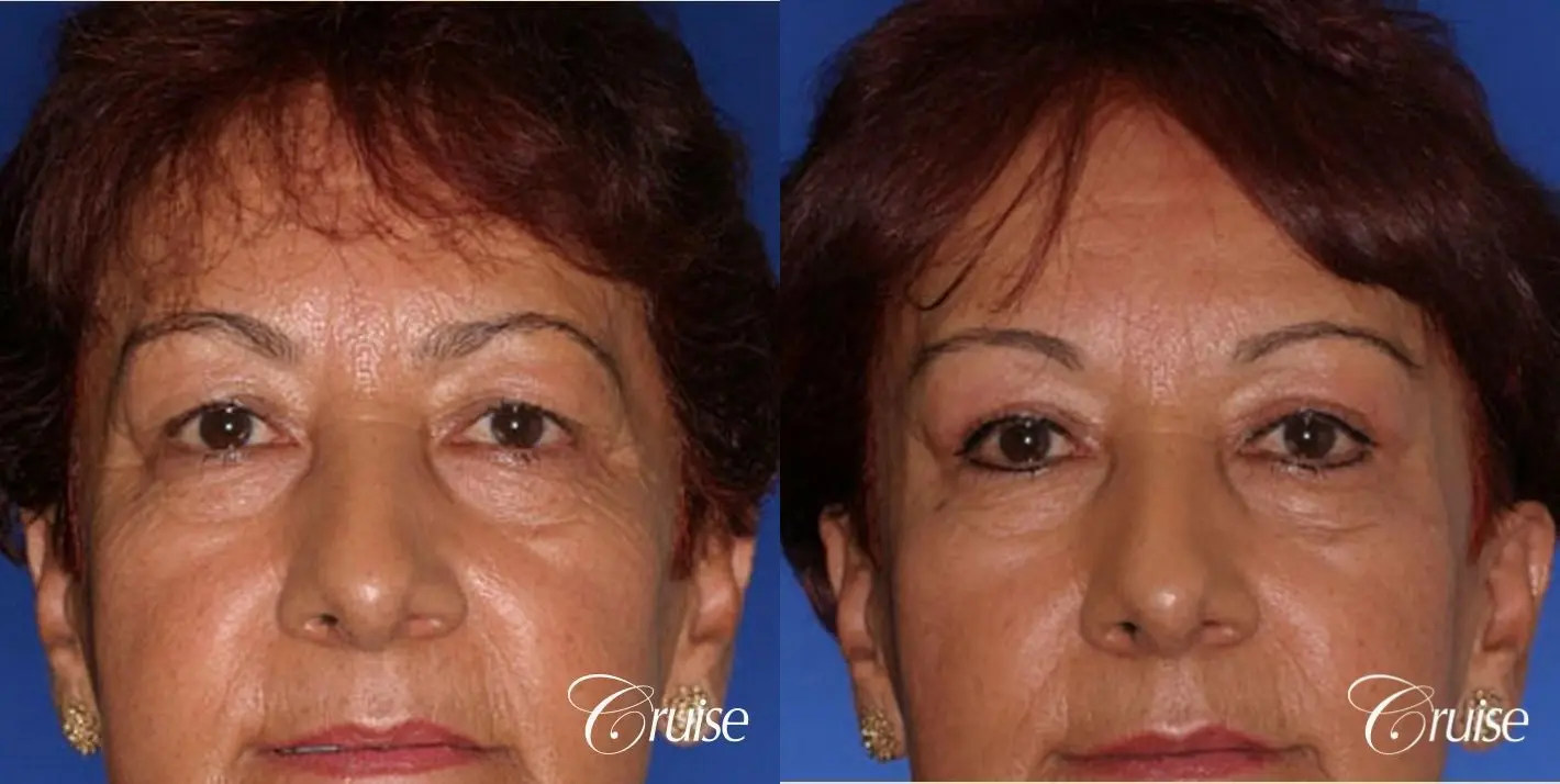 best temple lift dark skin tone - Before and After 1