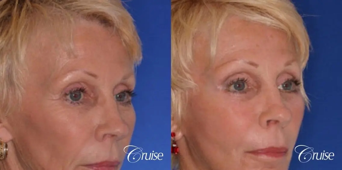 female with the best scars on a brow lift - Before and After 3