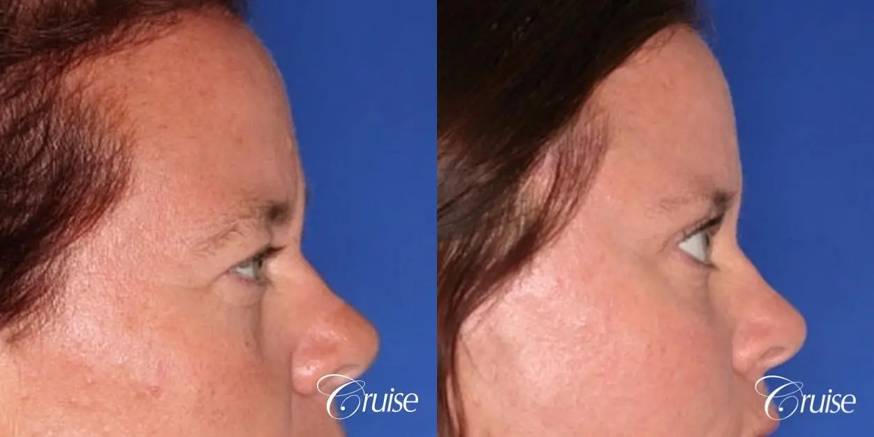 female temple lift and upper eyelid surgery - Before and After 3