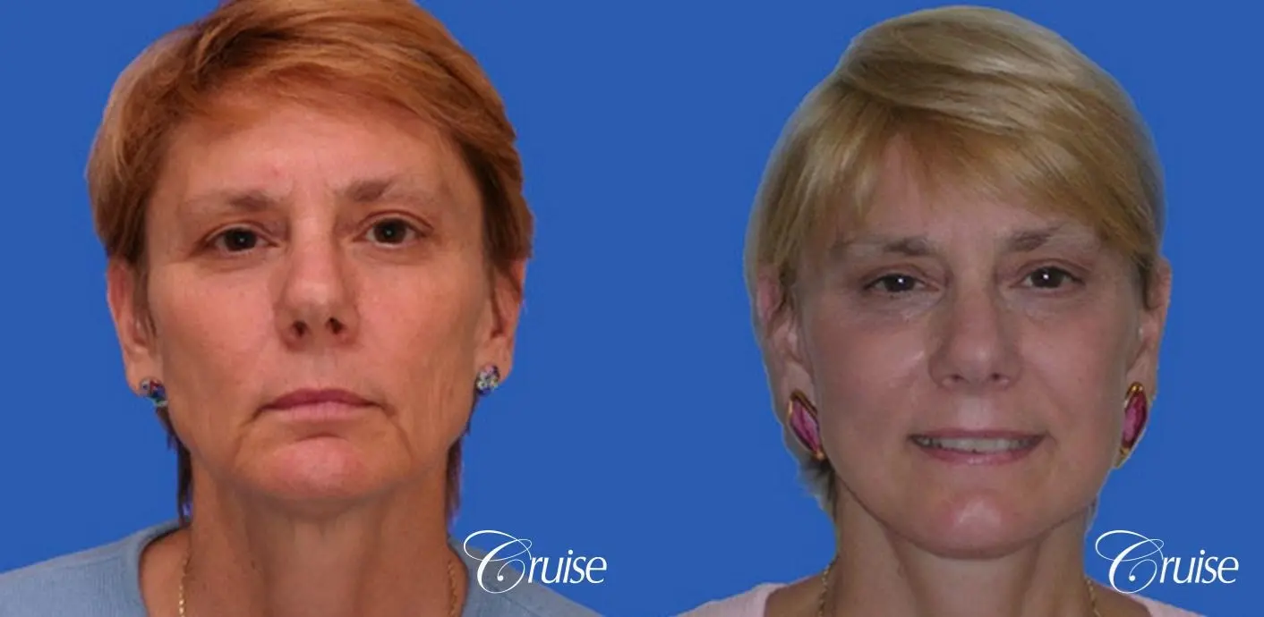 best neck and temple lift on female patient - Before and After 1