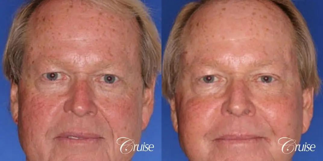 photos of men with temple and face lift - Before and After 1