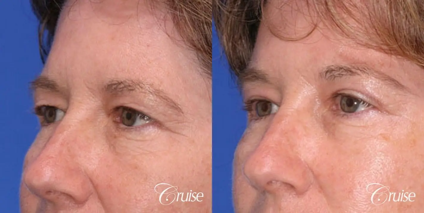 brow temple lift under local anesthesia - Before and After 3