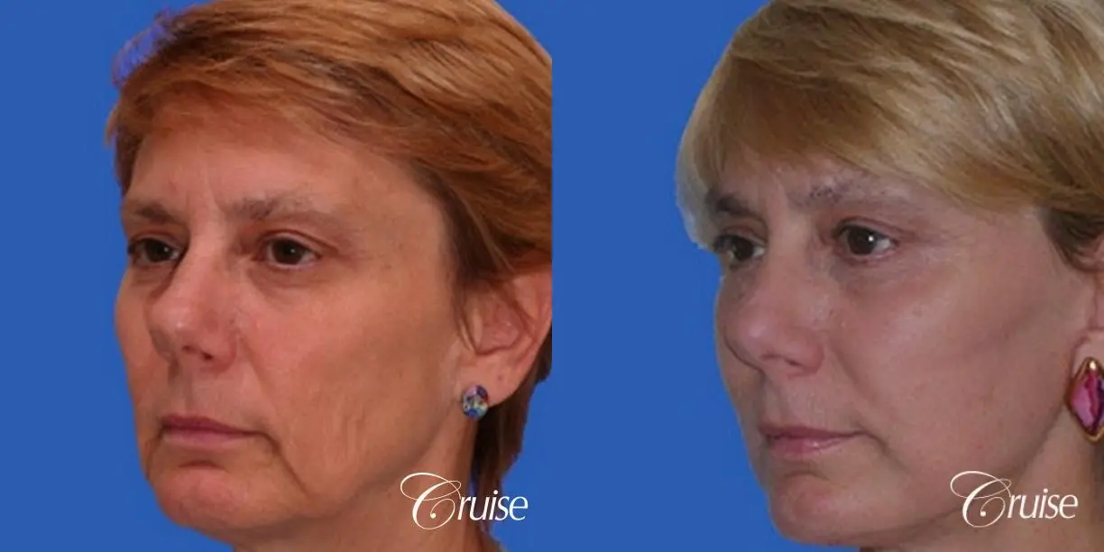 best neck and temple lift on female patient - Before and After 2