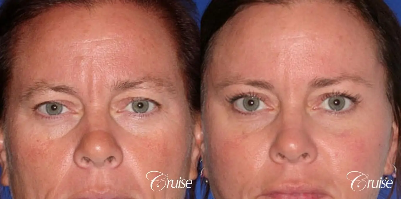 female temple lift and upper eyelid surgery - Before and After 1