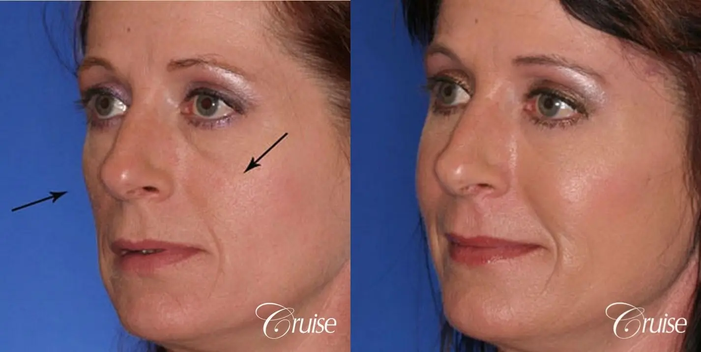 best temple lift facial rejuvenation to brighten eyes - Before and After 2
