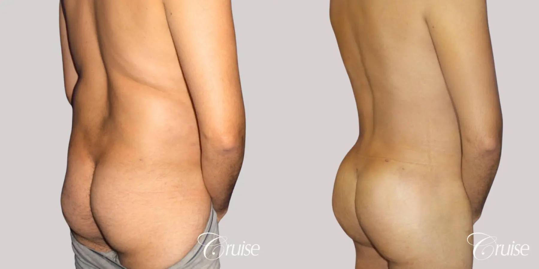 Butt Augmentation: Patient 1 - Before and After 3