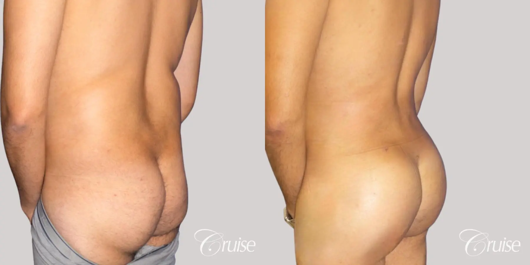 Butt Augmentation: Patient 1 - Before and After 2