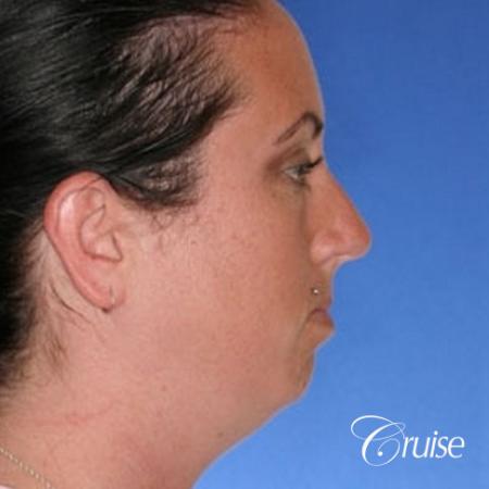 before and after photos of female chin implant - Before and After Image 4