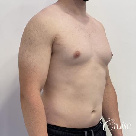 Gynecomastia: Patient 123 - Before 4