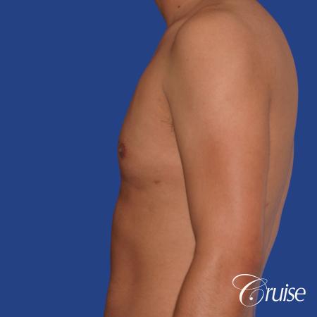 best gynecomastia results with plastic surgeon and specialist - After Image 2