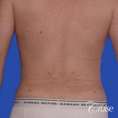 male muffin top liposuction pictures - After Image 1