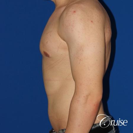 mild-gynecomastia-revision - After Image 2