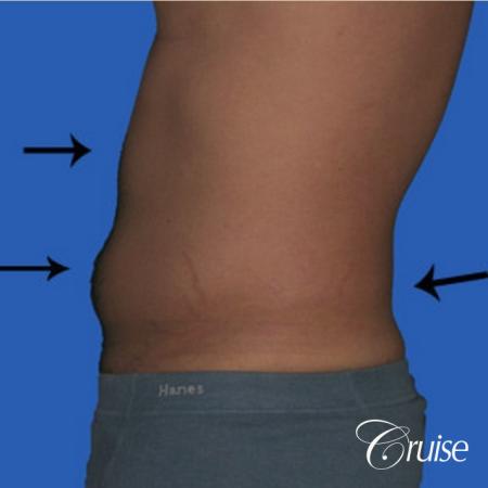 best liposuction to contour a males body - Before Image 2