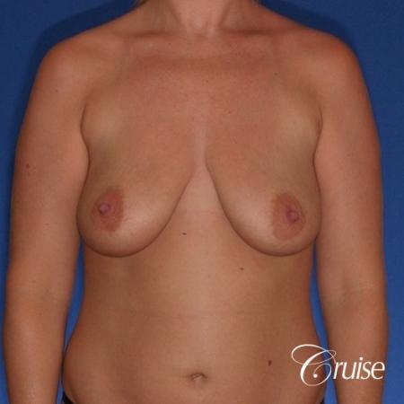 best before and after of breast lift anchor with high profile saline augmentation - Before Image 1