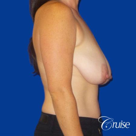 Breast Reduction No Implants - Before Image 3