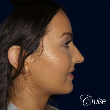 Rhinoplasty Dr. Cruise newport beach - Before Image 3