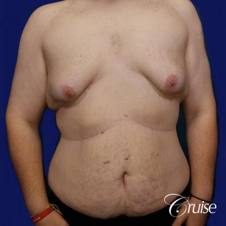 severe gynecomastia - Before Image 1