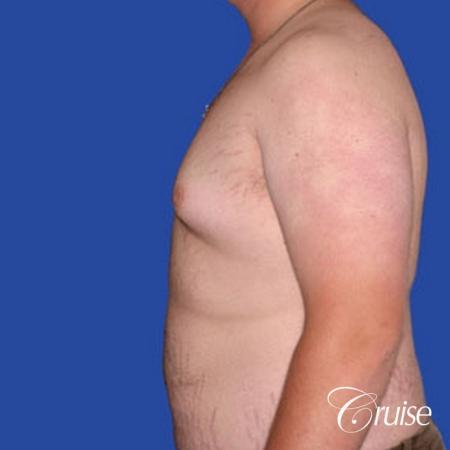 weight loss patient with gynecomastia - Before Image 2