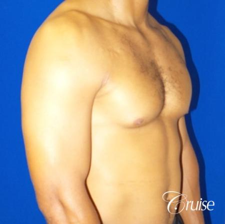 gynecomastia caused by testosterone - Before 2