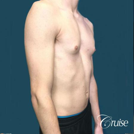 Top Gynecomastia Specialist Dr. Cruise - Before Image 5