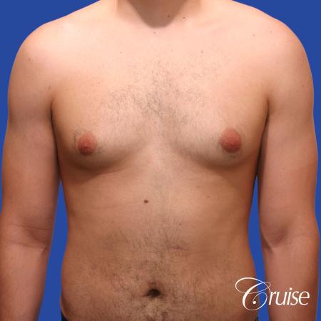 20 year old with moderate gynecomastia - Before Image 1