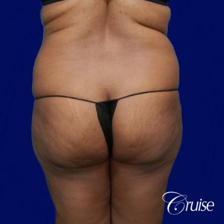 Liposuction Flanks - Before and After Image 4