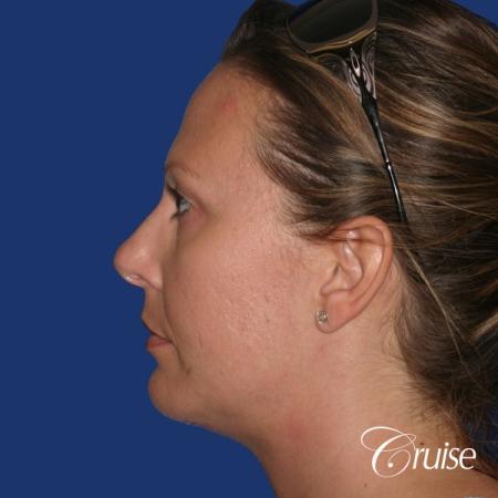 best before and after of chin augmentation medium implant - After Image 2