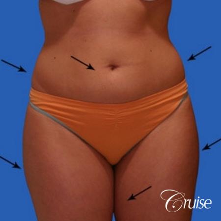 best liposuction results on abdomen, flanks, thighs - Before Image 1