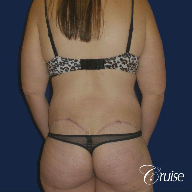 best circumferential tummy tuck photos -  After 3