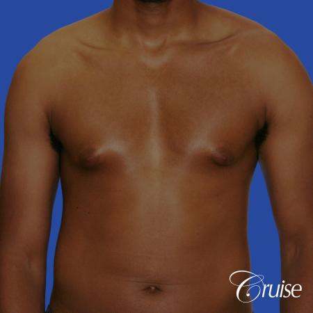 young body builder has puffy nipple and gets gynecomastia surgery - Before Image 1