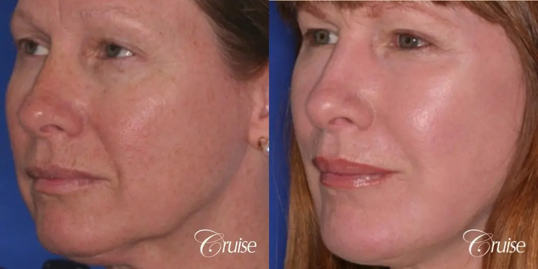 best chemical peel in newport beach - Before and After 2