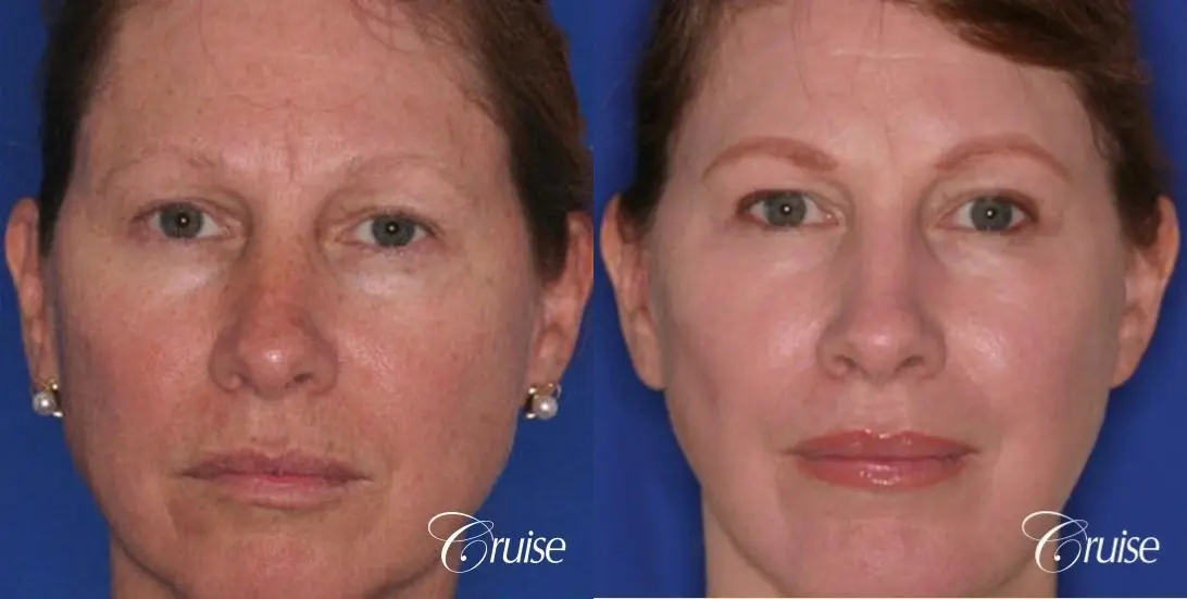 best chemical peel in newport beach - Before and After 1