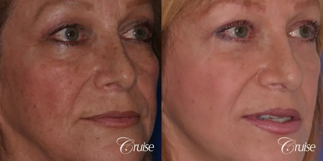 best chemical peel on female patient - Before and After 2