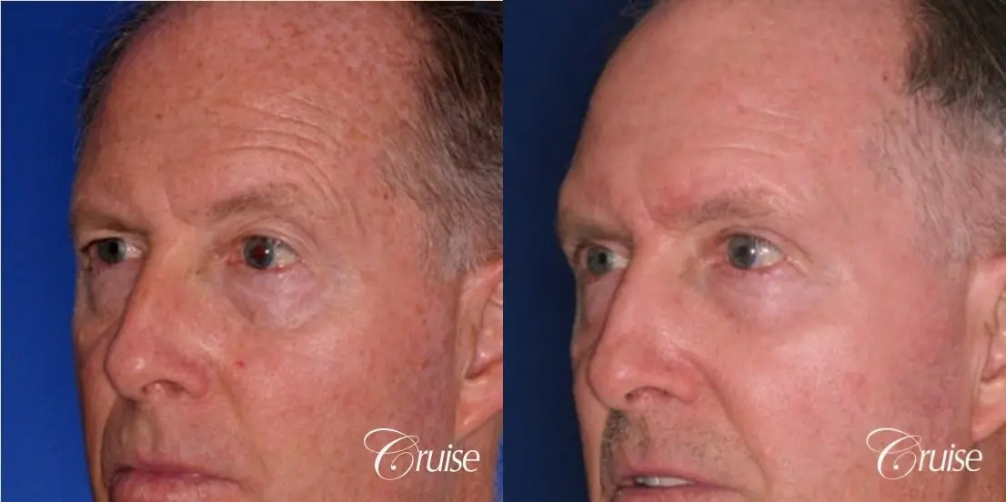 best chemical peel eyelid surgery - Before and After 2