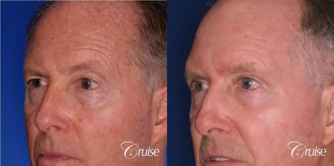 Chemical Peel Before & After