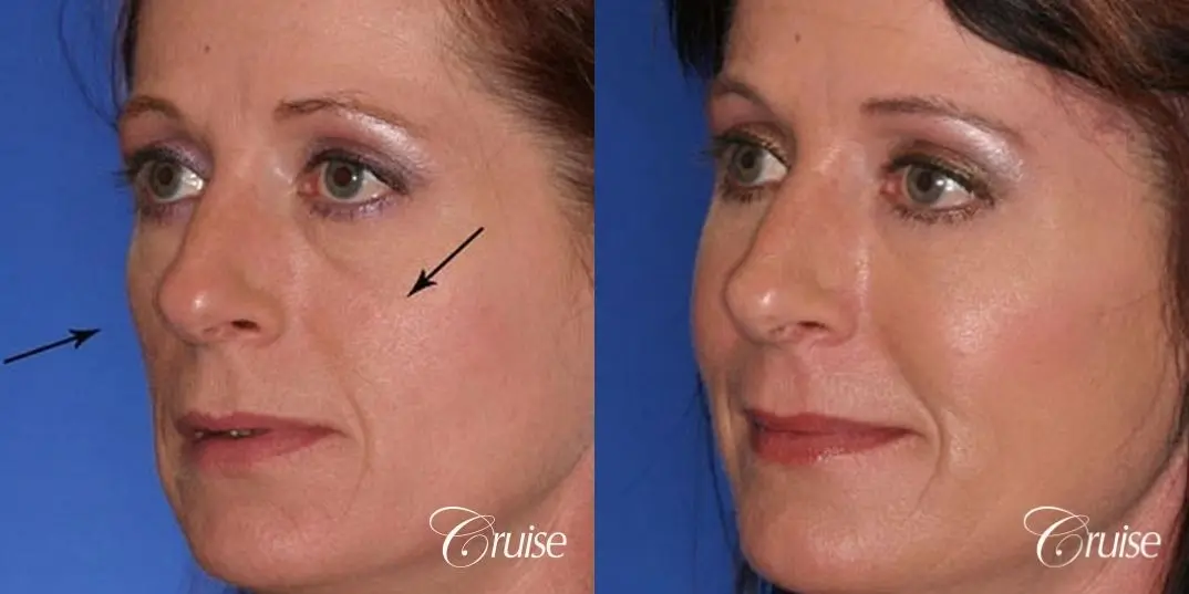 best chemical peel results - Before and After 2