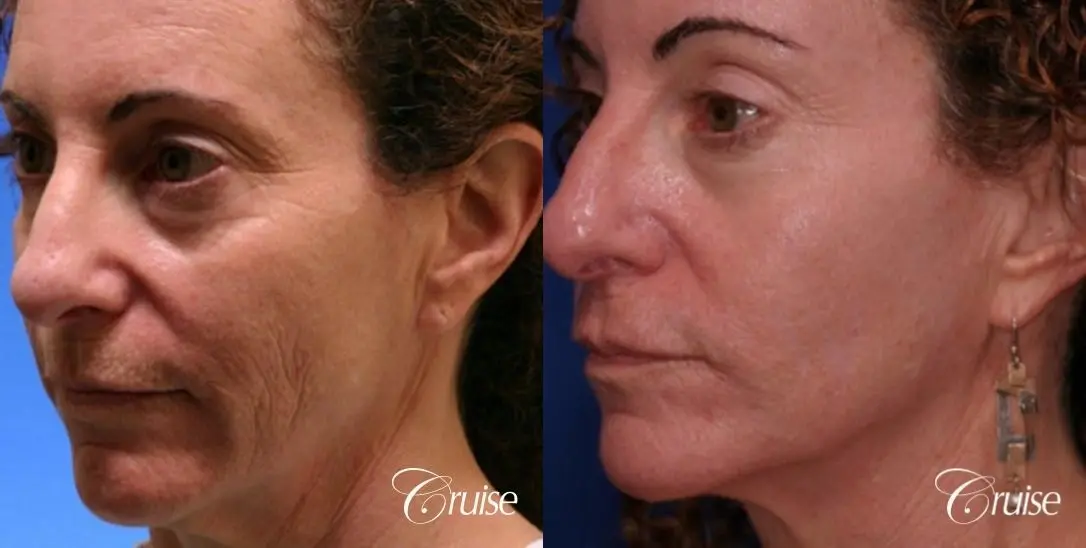 best female chemical peel - Before and After 1
