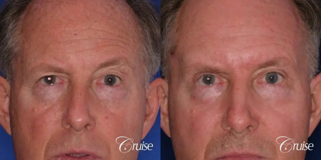 best chemical peel eyelid surgery - Before and After