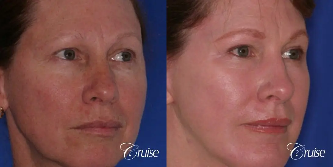 best chemical peel in newport beach - Before and After 3