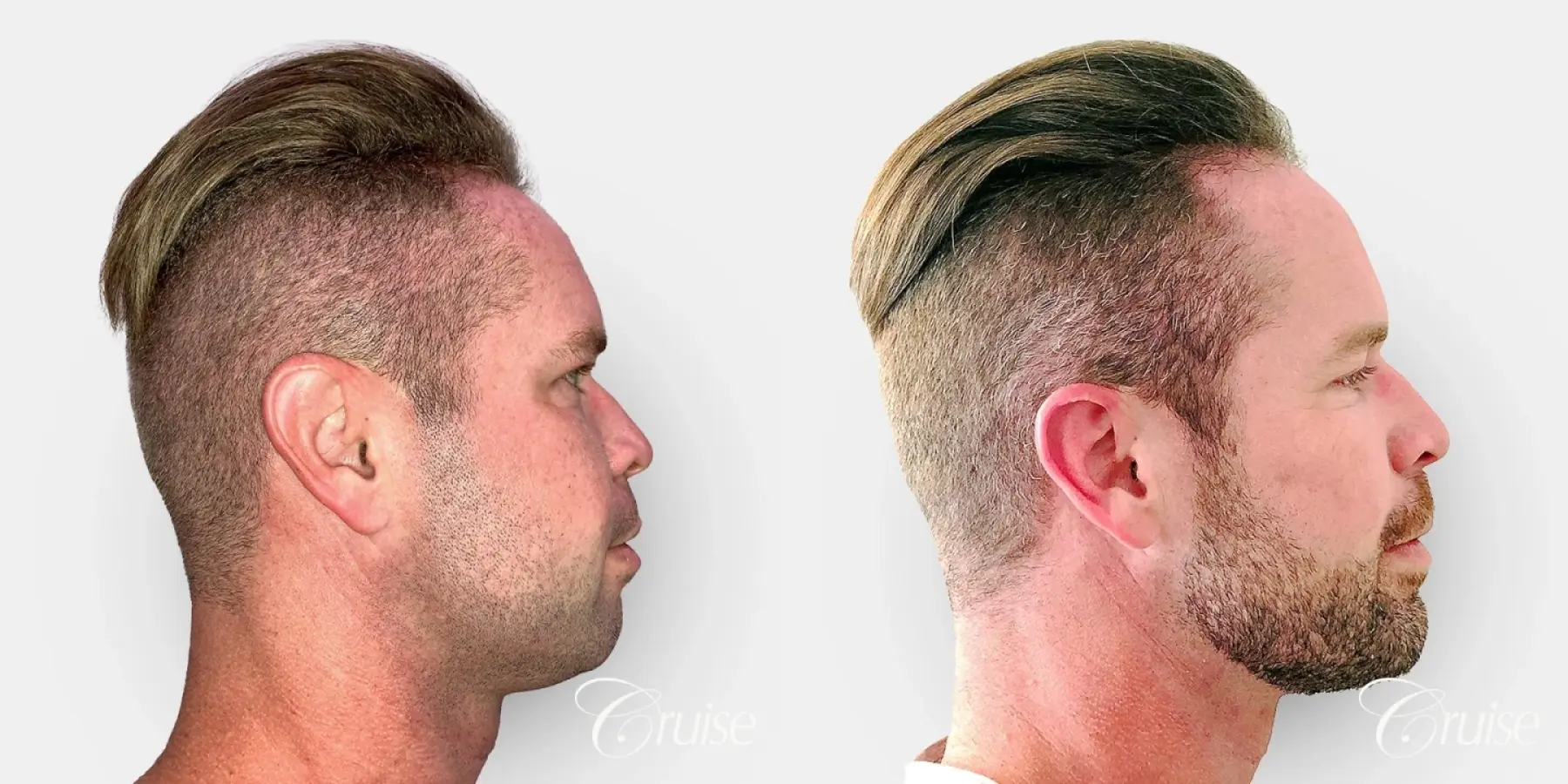 Male Chin Implant - Before and After 1