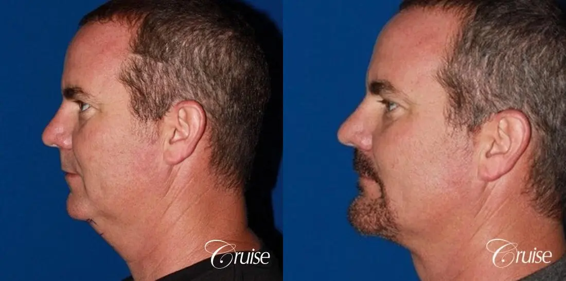 best pictures of chin augmentation with specialist - Before and After 2