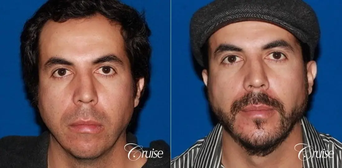 male patient with large chin augmentation - Before and After 1