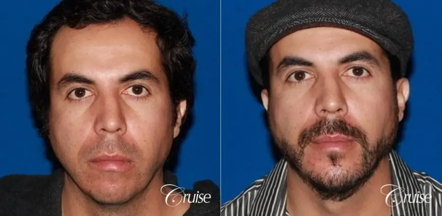 male patient with large chin augmentation - Before and After