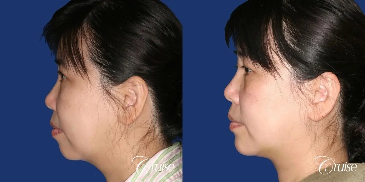 best chin implant photos with large implant - Before and After 2