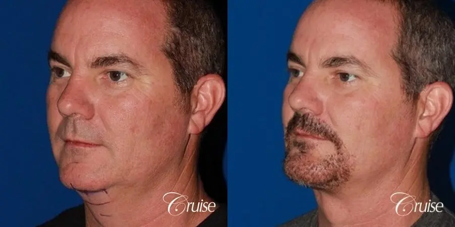 best pictures of chin augmentation with specialist - Before and After 3