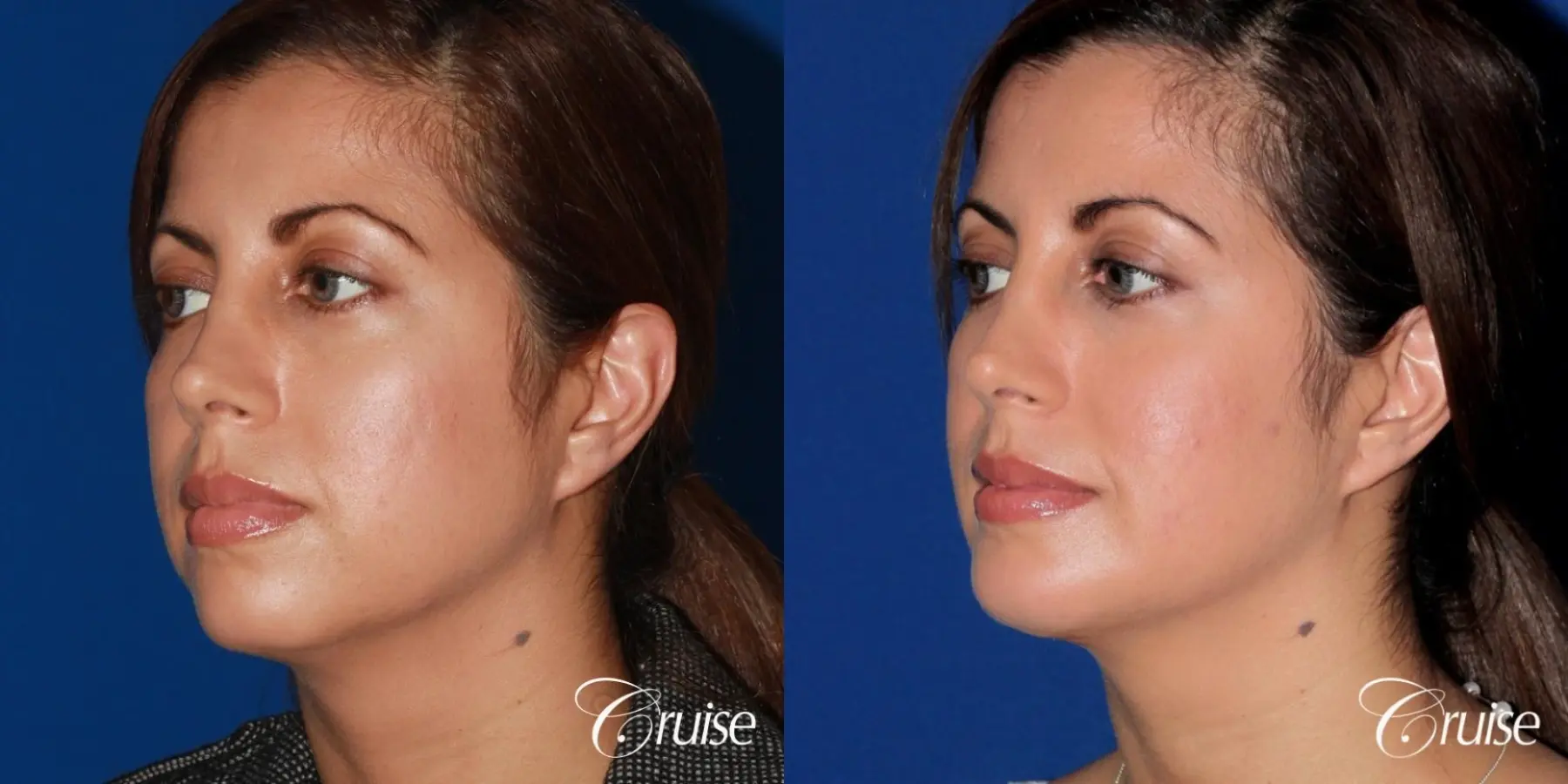 woman with large anatomic chin implant - Before and After 2