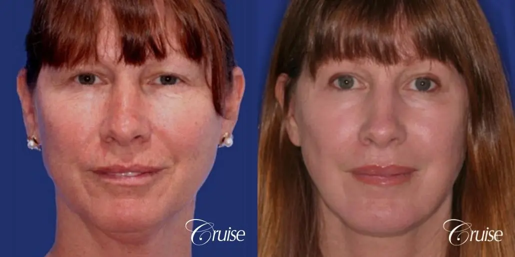 52 year old with chin augmentation and facelift - Before and After 1