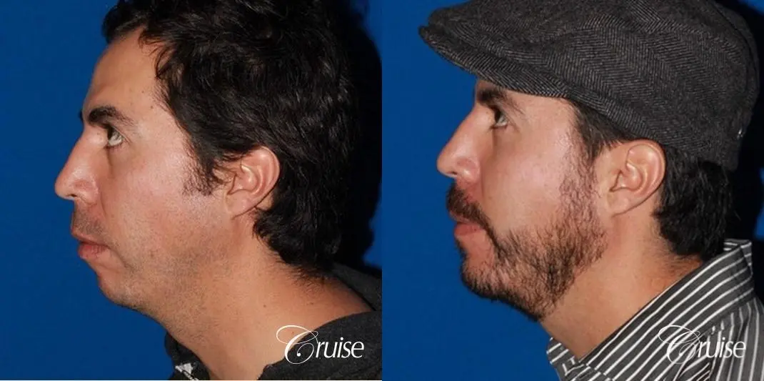 male patient with large chin augmentation - Before and After 2