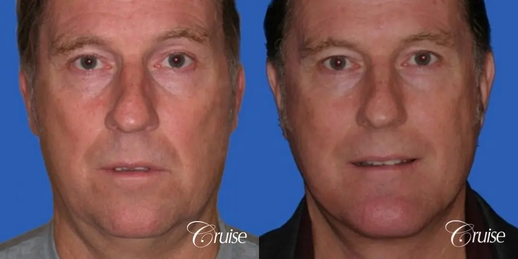 52 yr old male with medium square chin implant - Before and After 1